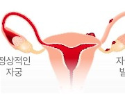 '여성의 적' 자궁내막증…K바이오, 치료 신약 개발 활발