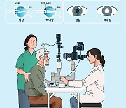 발병 시기 빨라지는 백내장…40대 환자 10년새 2.7배↑