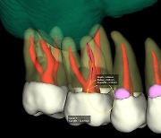 신경관까지 선명하게…바텍, AI 강화로 3D 치아 분리기능 고도화