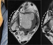 발목 인대 파열, 비절개 내시경 봉합술로 치료 부담 줄어 [장철영의 관절 BEST]
