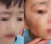 "초2 아들, 학원서 4학년한테 연필로 얼굴 긁혔다…학폭 맞죠"