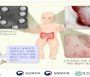 “백신 없어요” 영·유아 중심 수족구병 한 달 새 급증