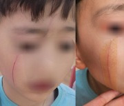 “초2 이마부터 턱까지 연필로, 4학년한테 긁혔다…가슴 무너진다”