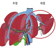 내게 맞는 간 찾기 어려울 때, 작은 간 이식해 몸속에서 키운다