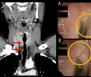 30년 흡연자, 몸 안좋아 병원갔더니 "목 안에 털이 있어요"