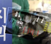 '전액 선납하면 할인' 믿었다간…임플란트 분쟁 급증