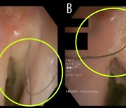 십수년간 목 안에 ‘털’ 자란 남성···30년 피운 담배 끊었더니 ‘놀라운 변화’