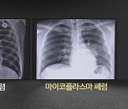 마이코플라스마 폐렴균 감염 환자 급증