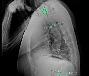 ‘척추 엑스레이 영상’ 10초 만에 분석하는 시스템 개발돼