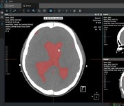 코어라인소프트, 강북삼성병원에 AI 뇌출혈 진단 솔루션 공급