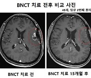 가천대 길병원, A-BNCT 개발로 '악성종양 교모세포종' 극복에 나서