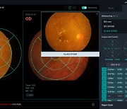 뷰노,국제 의료AI 대회 1위…'녹내장 판독 경쟁력' 입증