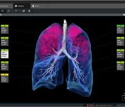 `사망률 1위 `폐암`…코어라인소프트, AI 의료기술로 조기 발견 돕는다