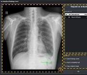 뷰웍스, 흉부 AI 진단 보조 솔루션 식약처 허가 획득