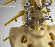 추간공확장술, ‘척추 수술 후 통증 증후군’ 치료에도 적용