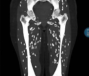 "가장 끔찍한 CT영상"…다리에 '쌀알 모양 기생충' 득실 왜?