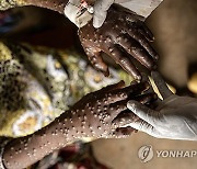 CONGO MPOX OUTBREAK