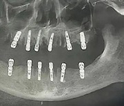 하루에 치아 23개 뽑고 12개 임플란트…13일 후 심장마비로 숨져