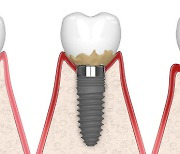 치주염보다 위험한 ‘임플란트 주위염’을 아시나요
