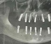 하루에 치아 23개 뽑고, 임플란트 12개 이식한 중국인, 13일 뒤 심장마비로 사망