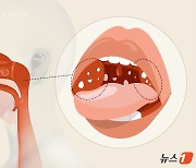 [100세건강] 쌀쌀해지니 또 목이 아프네…'환절기 불청객' 편도선염