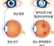 초기 당뇨에도 우려되는 시력 손상, 안과도 정기검진 필수 [중·꺾·마+: 중년 꺾이지 않는 마음]