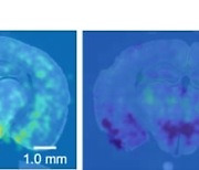 수술 없이 뇌질환 치료…서울대, 미세 충격파 전자약 개발