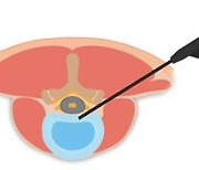 근육 벌려 뼈 깎는 수술도 옛말…당일 퇴원 가능한 척추병 새 치료법은