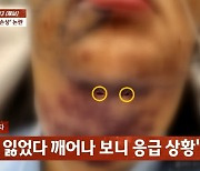 “턱에 구멍까지 뚫어”…지방흡입 후 ‘동맥 손상’된 여성