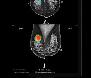 루닛 "유방촬영술 AI로 최대 6년전에 유방암 발생 예측 가능"