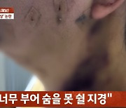 성형외과서 지방흡입술 하다 '동맥 손상'···"죽을 뻔" 따지자 의사가 꺼낸 말