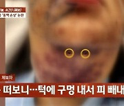 강남 성형외과서 지방흡입술 받다가 턱 뚫렸다..의사 "죽지는 않을 것"