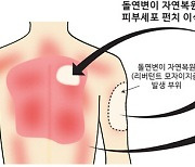 새로운 희귀 중증 유전성 피부질환 치료법 보고