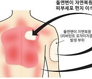 '가벼운 마찰에도 상처·수포' 희귀질환…국내의료진, 치료법 찾았다