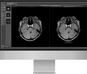 딥노이드, 뇌동맥류 AI 솔루션 최초 건강보험 임시등재