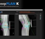 '인공관절' 4만례 공부한 AI…"최적 수술법" 의사에 추천[빠정예진]
