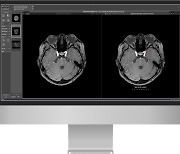 딥노이드 "뇌동맥류 AI 솔루션, 건강보험 임시등재"