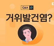 운동하다 찌릿한 무릎, '거위발건염'일 수도 있다고? [1분 Q&A]