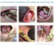 시리즈벤처스, 치과용 임플란트 상부 구조물에 투자[fn마켓워치]