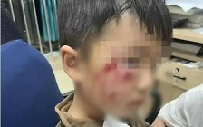 광견병 백신 접종 18일 뒤 사망한 中 3세 아이…면역 실패에 당국 조사[여기는 중국]