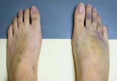 발등 부음 혹 증상 있다면? '이것'일 수 있습니다. 이미지