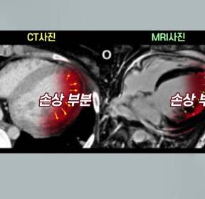 코로나19로 '심근염'.."다른 장기에 영향" 국내 첫 사례