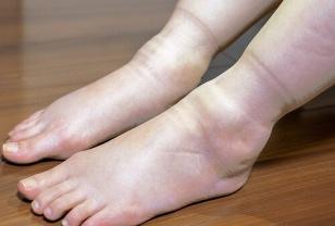 당뇨병 오면 "발에 이 증상부터 찾아옵니다" 확인하세요. 이미지