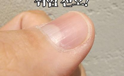 손톱 울퉁불퉁하고 세로줄까지...? '이것'이 부족하다는 위험신호! 이미지
