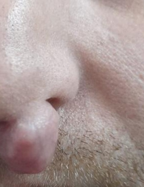 "코 아래로 점점 커지는 덩어리"… 쿠웨이트 30대 男, 코밑 종양 정체는?