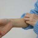 손발이 땀에 젖거나 상처 생기면… HPV에 감염돼 '사마귀' 생기기 쉬워