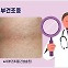 겨울철 가려움 유발, ‘건선’과 ‘피부건조증’ [건강 나침반] 