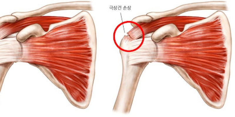어깨 부상의 70%는 이것 때문?!(어깨통증, 회전근개) | 더베네핏