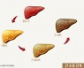 비알콜성 지방간염, 치료제 개발 실마리 찾았다