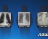 [사진] 건강한 폐 vs 흡연자의 폐 vs 코로나 환자의 폐